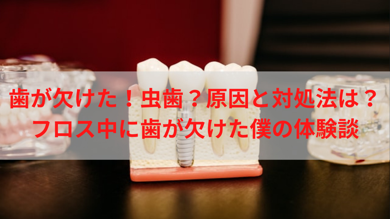 歯が欠けた 虫歯 原因と対処法は フロス中に歯が欠けた僕の体験談 生きてるだけで大吉